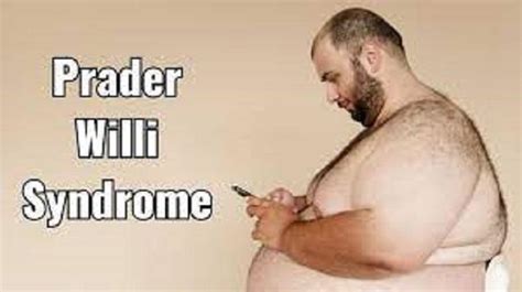 prader willi syndrome epidemiology